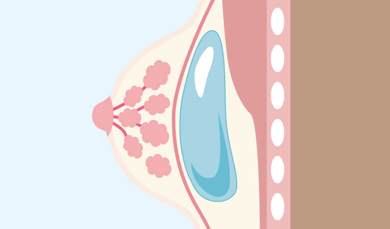 シリコンバッグ豊胸（人工乳腺バッグ）イメージ