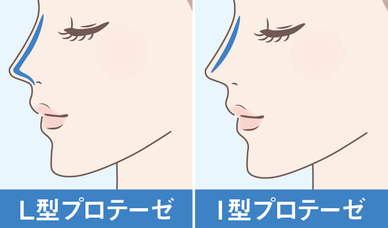 隆鼻術プロテーゼイメージ